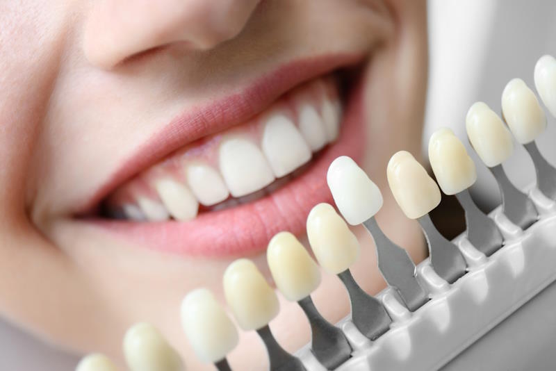 Close-up of a bright smile with a shade guide for teeth whitening. Aura Dental Centre offers cosmetic dentistry for a confident smile.